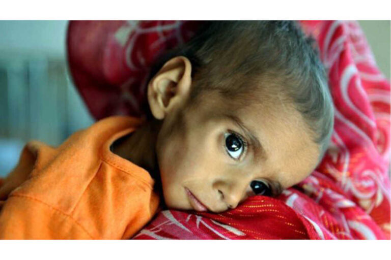 Hunger and Malnutrition Yet to be Eradicated in India